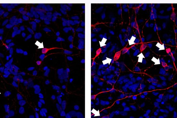 Avances en el Parkinson: Células madre seguras y efectivas