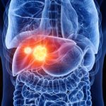 Descubre cómo prevenir 3 de cada 5 casos de cáncer de hígado