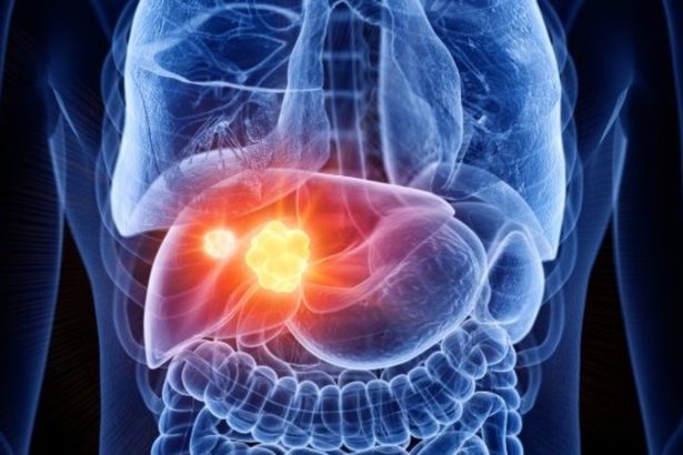 Descubre cómo prevenir 3 de cada 5 casos de cáncer de hígado