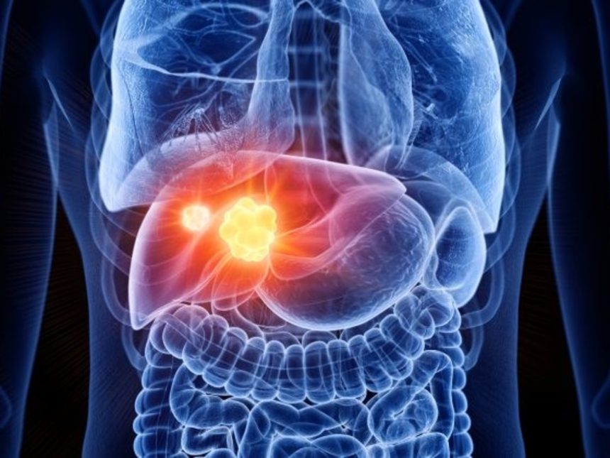 Descubre cómo prevenir 3 de cada 5 casos de cáncer de hígado