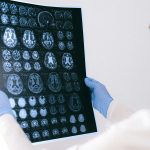 Descubren dos vacunas que podrían combatir el Alzheimer: ¡Increíble!