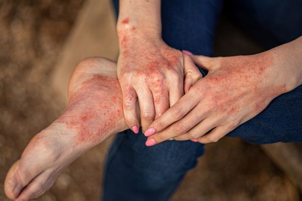 Dermatitis Atópica en Adultos: Aumento de Casos y Sus Causas