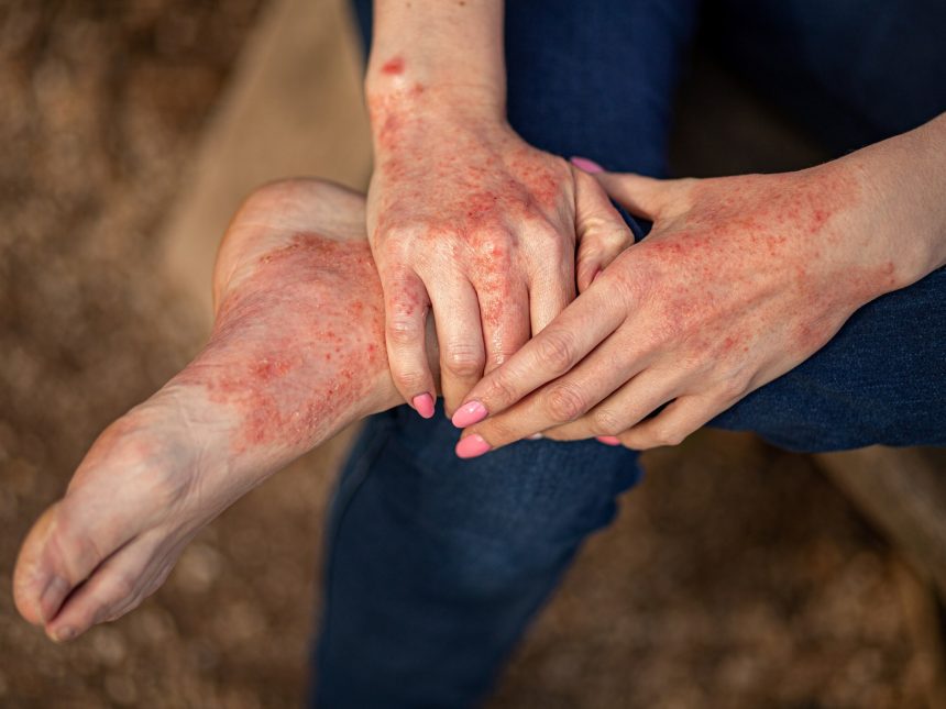 Dermatitis Atópica en Adultos: Aumento de Casos y Sus Causas