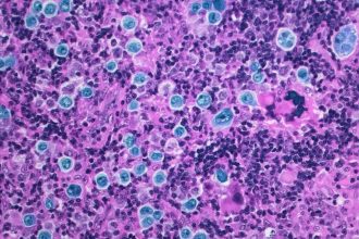 Revolución en Oncología: Médicos Israelíes Avanzan en Tratamiento del Cáncer