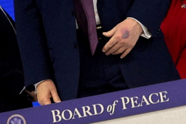 Trump genera inquietud por moretones en sus manos: ¿golpeó una mesa?