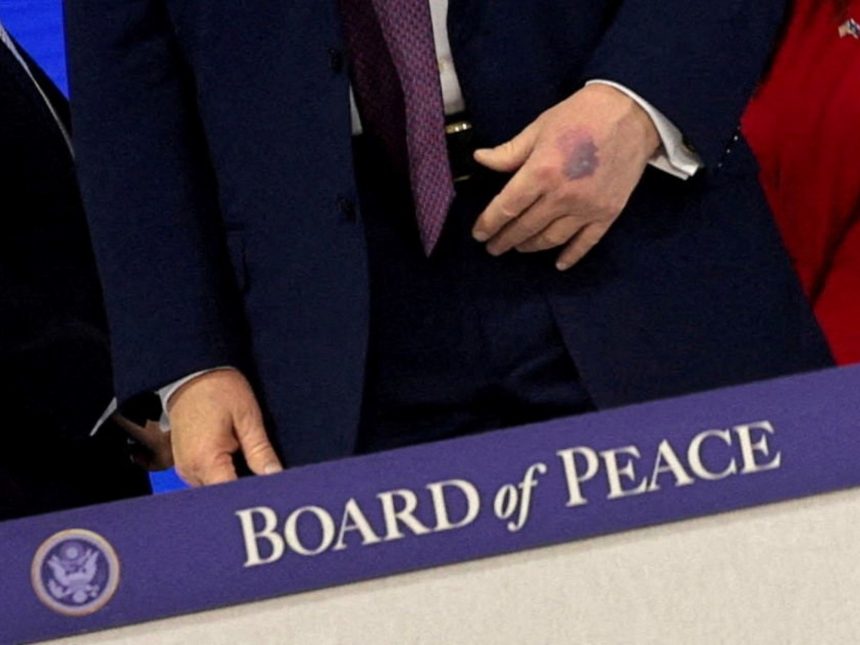 Trump genera inquietud por moretones en sus manos: ¿golpeó una mesa?