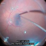 Innovadora solución para cirugía ocular riesgosa: ¡Séptimo Óscar!