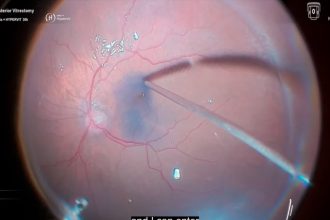 Innovadora solución para cirugía ocular riesgosa: ¡Séptimo Óscar!