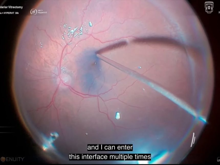 Innovadora solución para cirugía ocular riesgosa: ¡Séptimo Óscar!